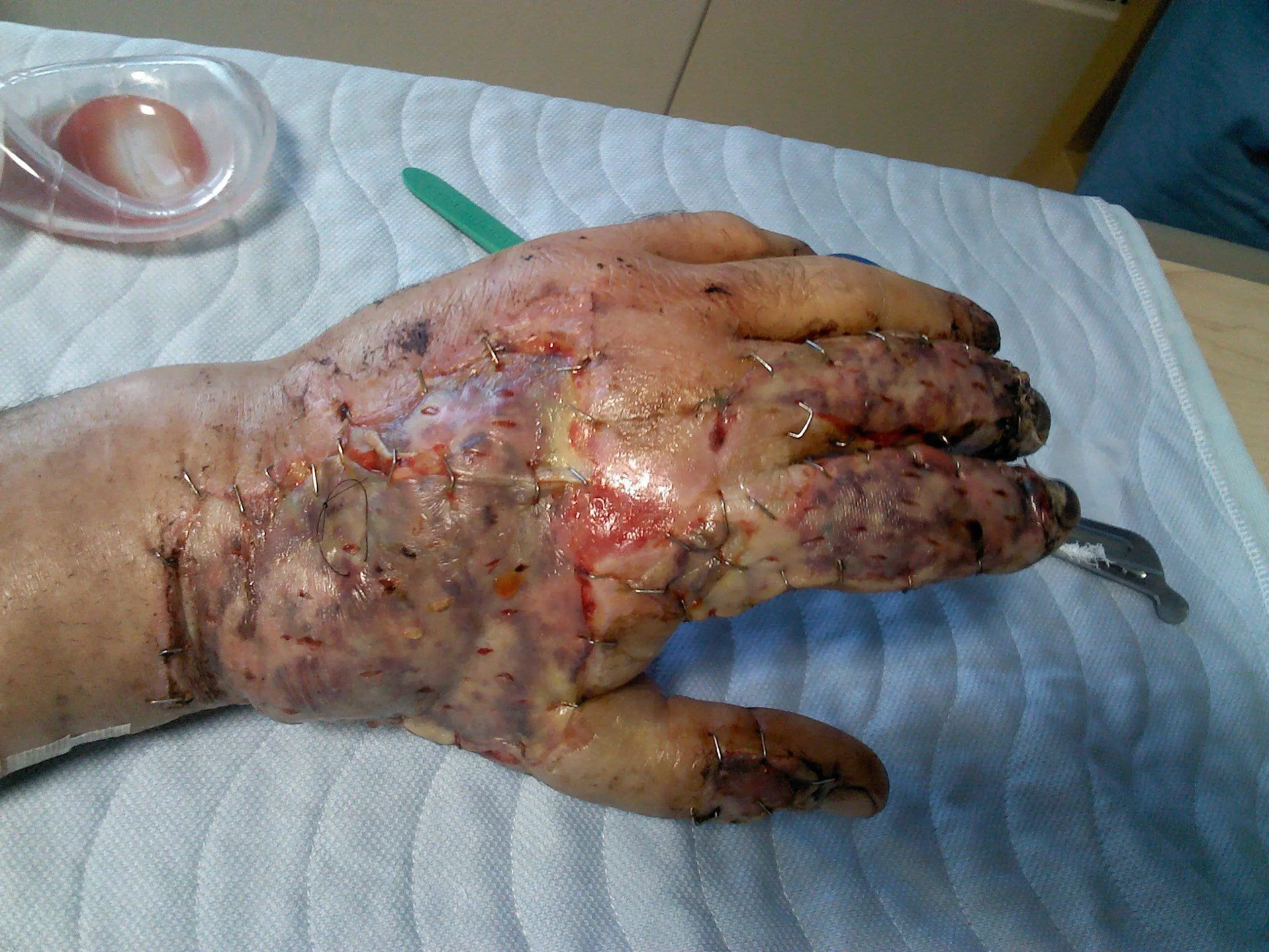 NSFW Skin graft after industrial laminator melted off the skin and chewed a hole through my father's hand.